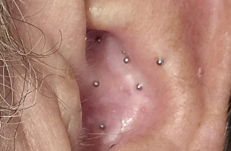 Alpha Gal Syndrome – Aricular Therapy Treatment Day 2)